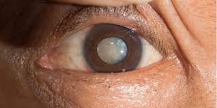 An image of an eye with a cataract
