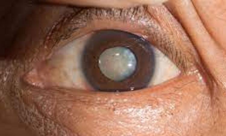 An image of an eye with a cataract